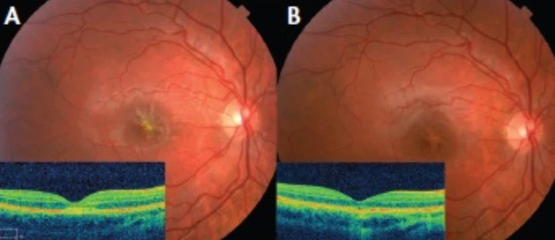 laser damage laser damage